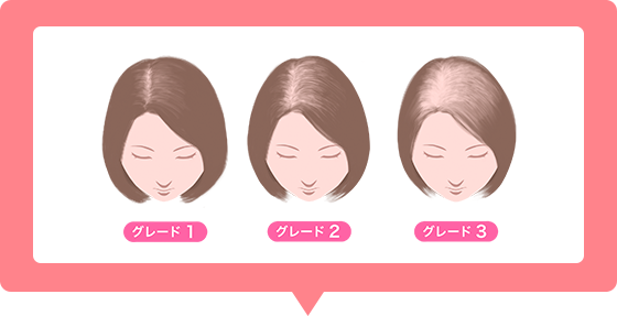 女性AGAの進行イメージ